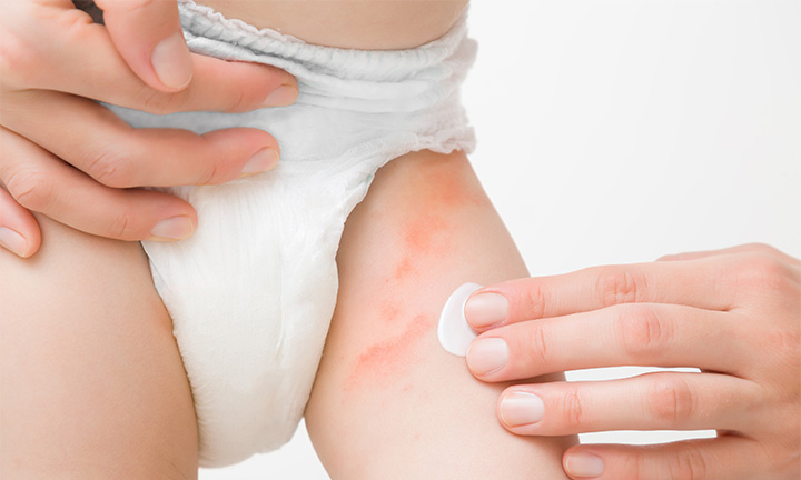 Diaper Duty Disaster? No Problem! Your Battle Plan For Yeast Diaper Rash